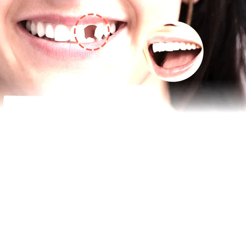 100g tooth repair - tooth,