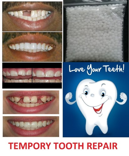 Temporary tooth repair kit fix - repair,
