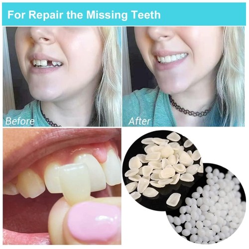 Tooth repair kit - repair, missing