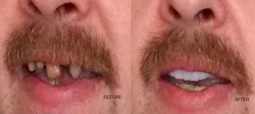 Temporary tooth repair - tooth,