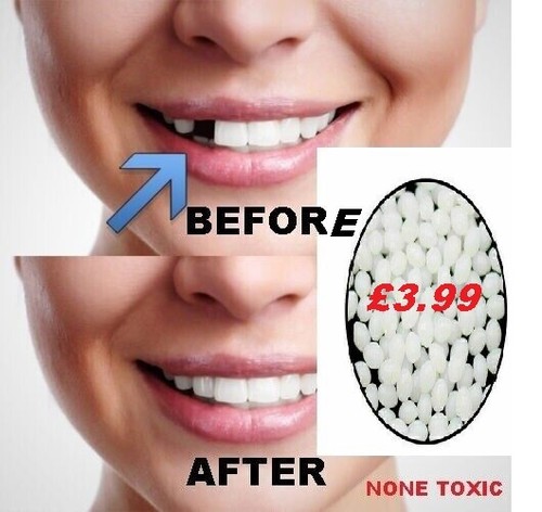 Temporary tooth repair kit fix - repair,