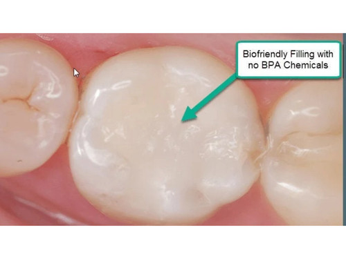Chipped tooth filling kit diy - kit,