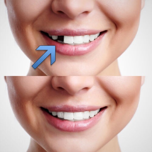 Temporary tooth repair - tooth, kit
